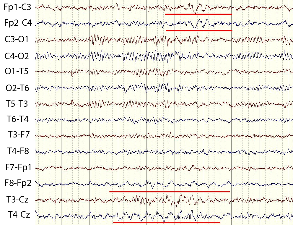 Ээг дельта. Острая-медленная волна на ЭЭГ. Дельта активность на ЭЭГ. ЭЭГ эпилепсия пик-волна. Пик волна на ЭЭГ.