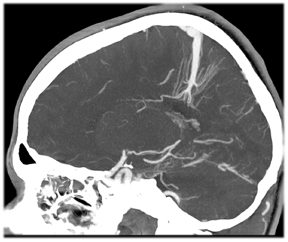 Сосудистая аномалия. Ангиома головного мозга кт. Венозная ангиома головного мозга кт.